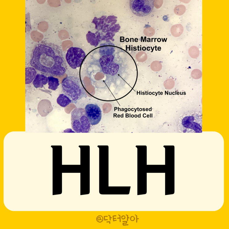  HLH 혈구탐식성 림프조직구증식증의 정의 증상 분류 진단 및 치료