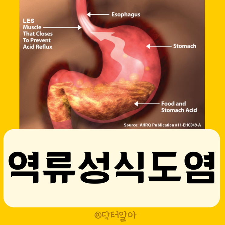  위식도역류질환(GERD, 역류성식도염)의 정의, 원인, 증상, 진단, 치료