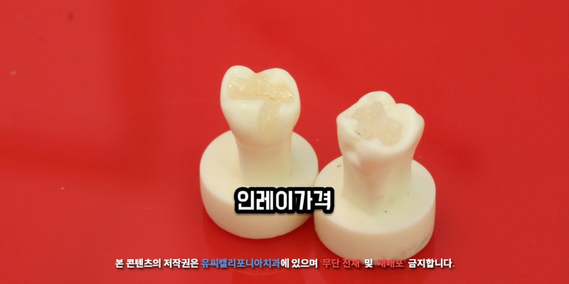 인레이 가격 종류 세라믹 vs 레진 그리고 그 중간 하이브리드 인레이?