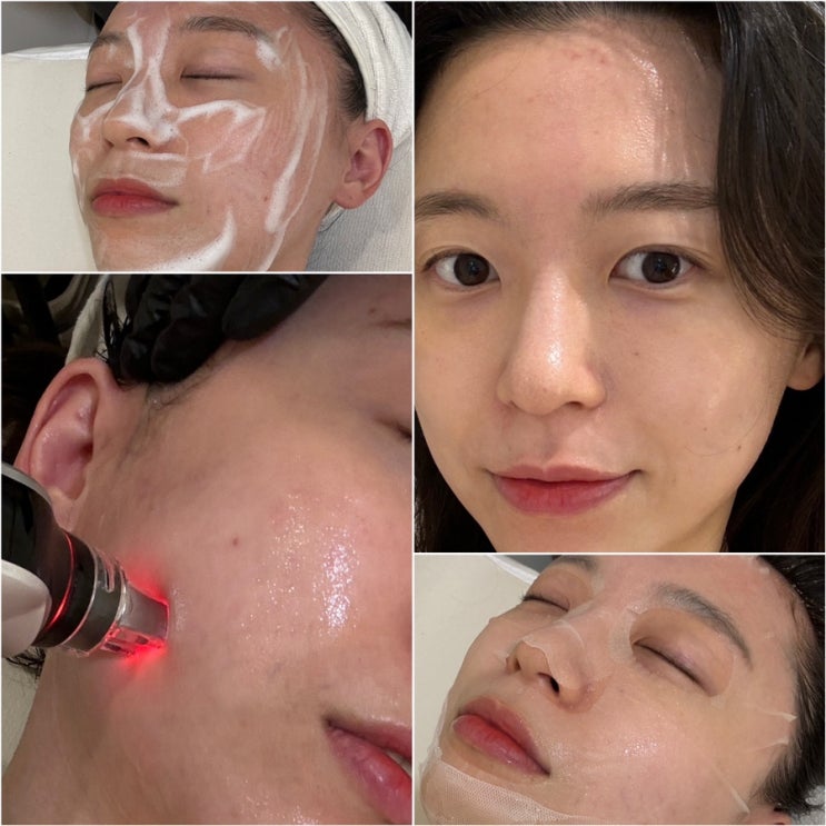  광명 피부관리 윤스뷰티 바쿠나 pp앰플 MTS+EMS 여드름관리