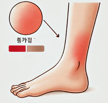  어린이 발 봉와직염 발이 퉁퉁 부었다면 통증 입원 재발
