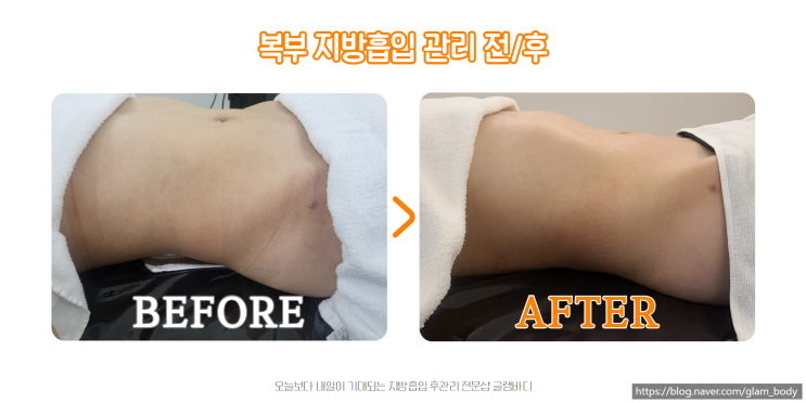  복부 지방흡입 붓기, 바본 후관리로 자연스럽게 줄이는 법