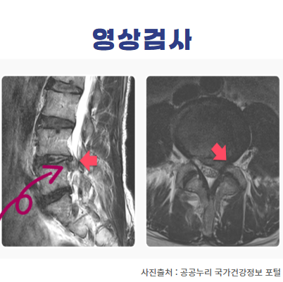 요추 경추 추간판탈출증 디스크 원인 증상 진단 Lasegue 라세그 검사 : 네이버 블로그