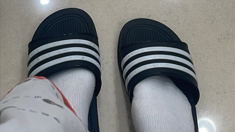 배꼽에 피지낭종나서 수술한 썰 푼다