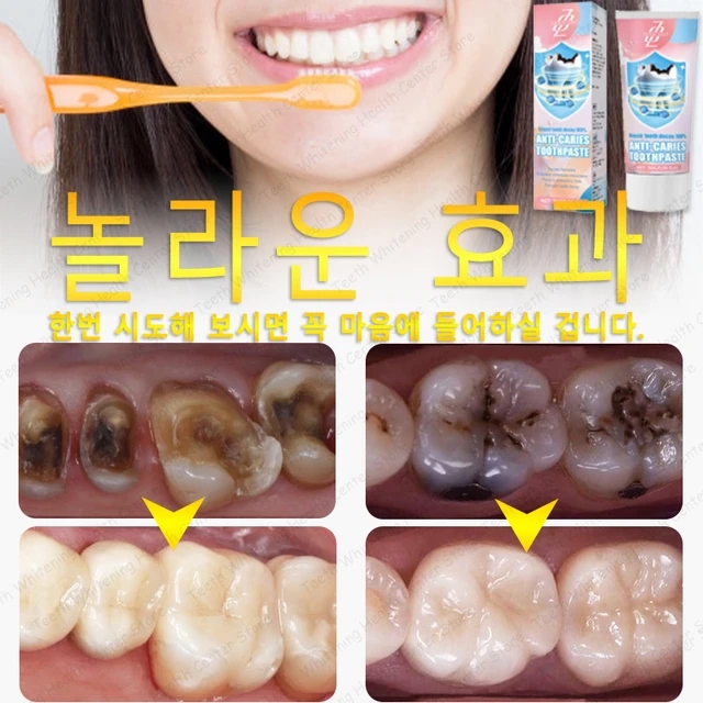 불소치약의 놀라운 효과? 충치도 없애준다? 속지 마세요! 불소는 충치를 예방해 주는 효과입니다. 불소치약의 놀라운 효과? 충치도 없애준다? 속지 마세요! 불소는 충치를 예방해 주는 효과입니다.