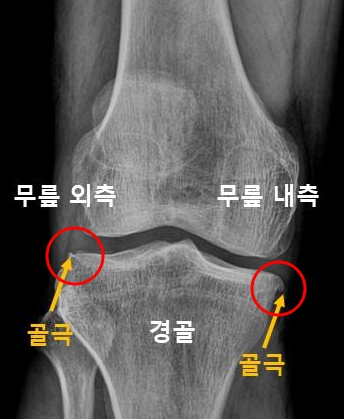  광주 무릎정형외과, 오른쪽 무릎 안쪽 통증이 생겼어요