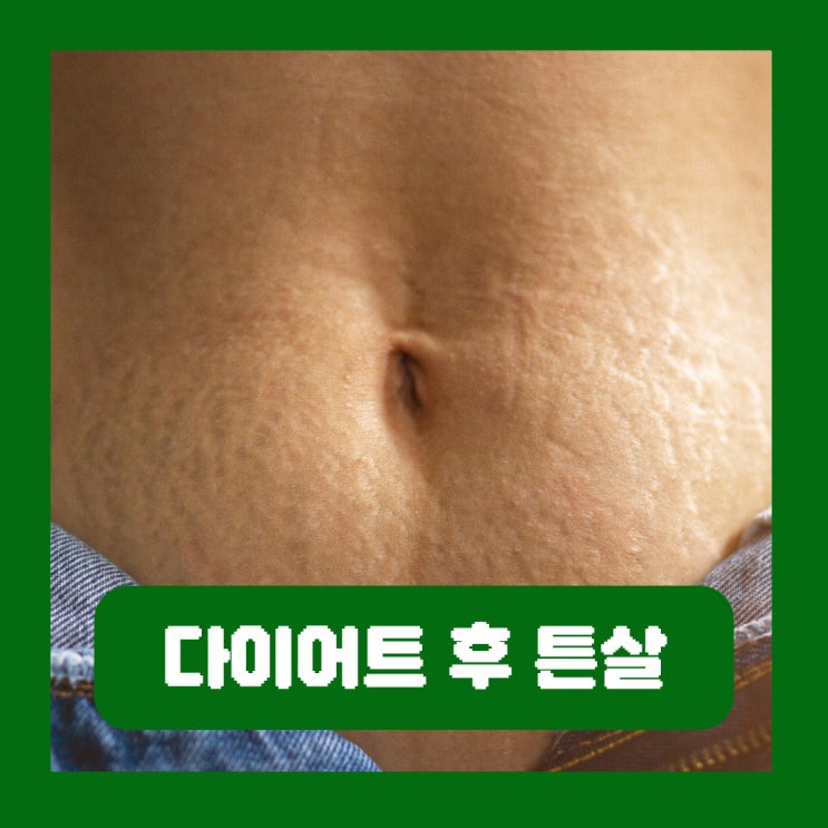  다이어트 후 튼살 생기는 이유 출산 살 뺀 이후 배 관리