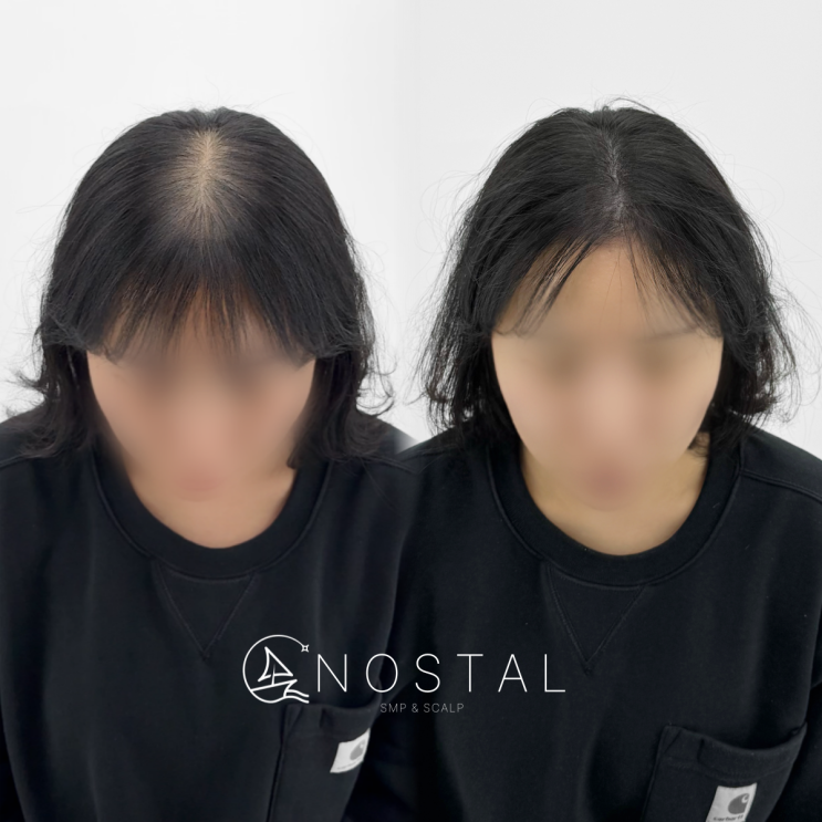  대전SMP가르마두피문신 탈모커버 잘하는곳