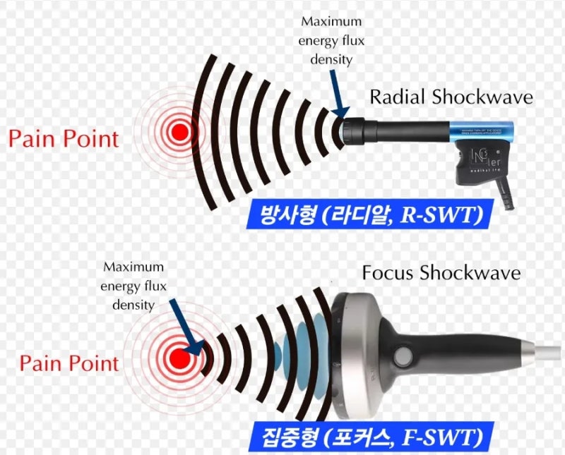 체외충격파(ESWT) 치료의 최신 가이드라인 (주의사항, 절대 받아서는 안되는 경우) : 네이버 블로그