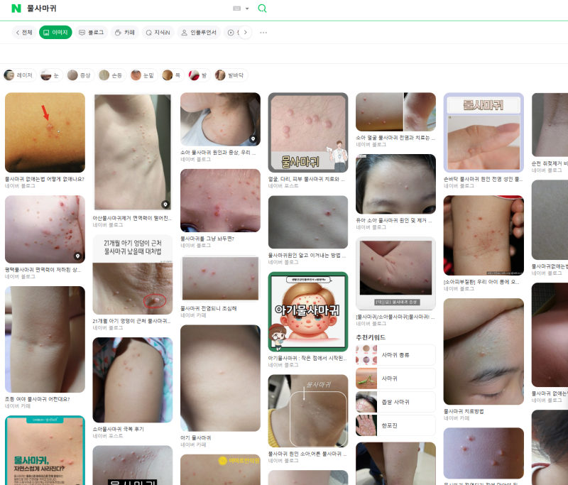 화곡동 물사마귀 치료 한의원