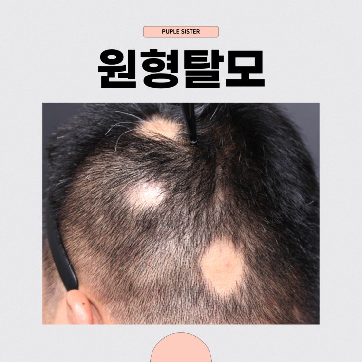  덕양구피부과 원형탈모가 점점 커지는 이유, 탈모약, 내성 안생기는 법