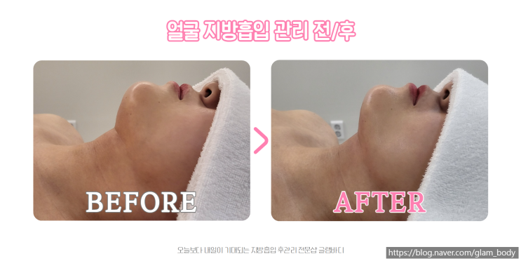  이중턱 지방흡입 후 바본 관리로 완성하는 아름다운 턱선
