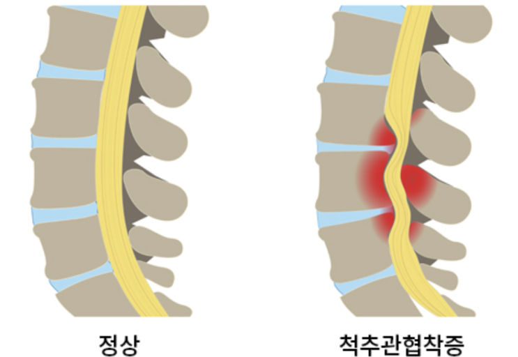  허리에 좋다는 신전운동을 해도 여전히 허리가 아프신 분들 / 대구체형교정
