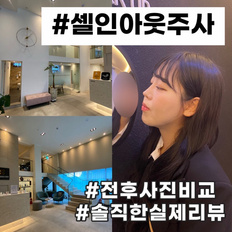  압구정 성형외과 셀인아웃 주사 볼륨 콜라겐 쥬베룩 후기