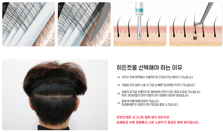 강남 모발 이식 솔직 후기 모먼트 의원 절개 비절개 히든컷 서울 모발이식 잘하는 곳 노컷 인비저블컷 디컷 모낭염 m자 원형 탈모 남성 무흉터 3단봉합 식모기 모낭 채취 1일차 강남 모발 이식 솔직 후기 모먼트 의원 절개 비절개 히든컷 서울 모발이식 잘하는 곳 노컷 인비저블컷 디컷 모낭염 m자 원형 탈모 남성 무흉터 3단봉합 식모기 모낭 채취 1일차