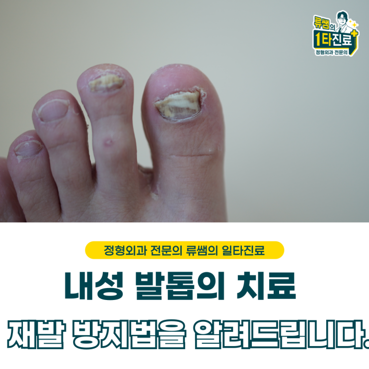  내성발톱 치료와 재발을 막는 방법을 알려드립니다.   (의사작성)