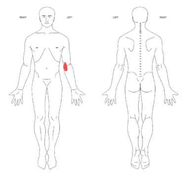  팔꿈치 골절 재활, 팔꿈치 펼 때 느껴지는 통증 해결할 수 있을까요?