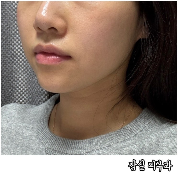  잠실피부과 잡티 제거를 위한 색소치료 인모드멍 후기