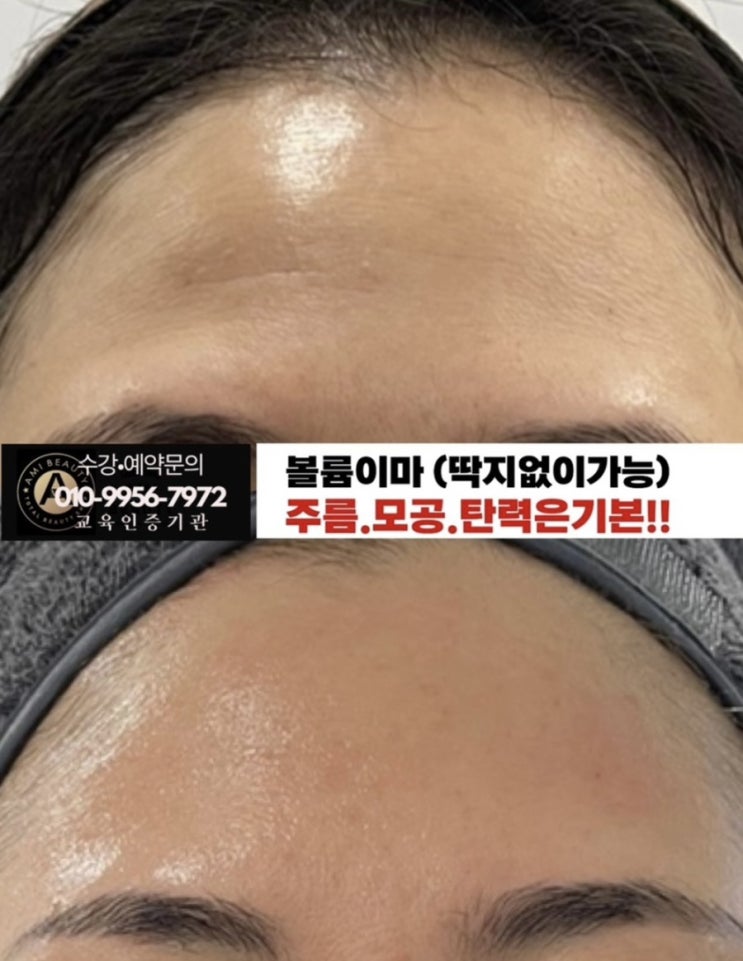  플라즈마 전국 최다임상, 아미뷰티에서 이마볼륨과 이마주름 고민을 완벽히 해결하세요