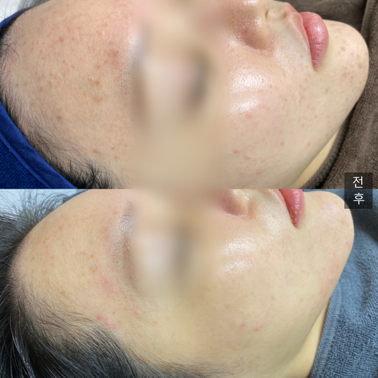  부천 피부 뒤집어졌을 때 이렇게 복구해 드립니다.