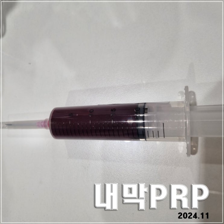  내막 PRP : 수지마리아 PRP 과정 · 비용 · 스모프리피드주사