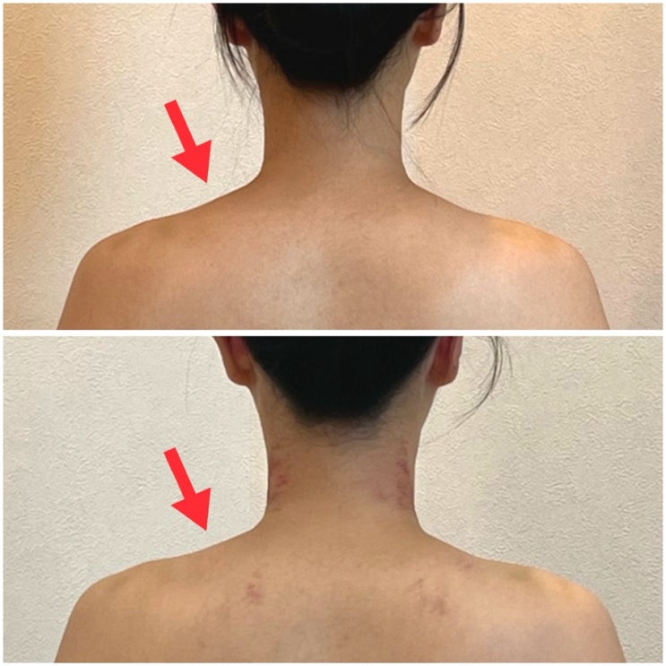  광주 승모근관리 해윤 치평동 바디관리 잘하는곳 다녀왔어요