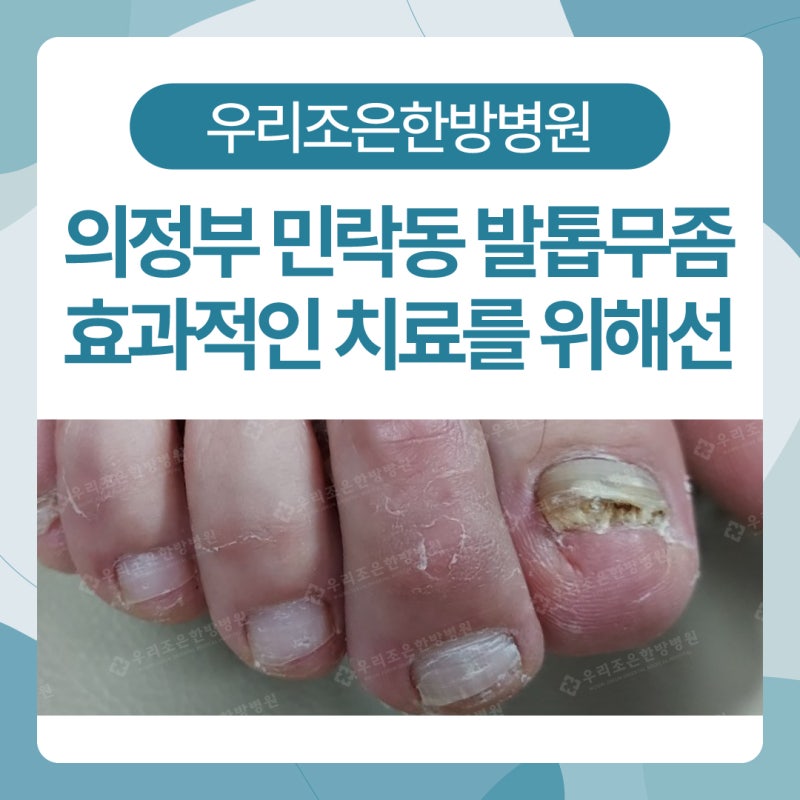 의정부 민락동 발톱무좀 원인과 효과적인 치료를 위해서는