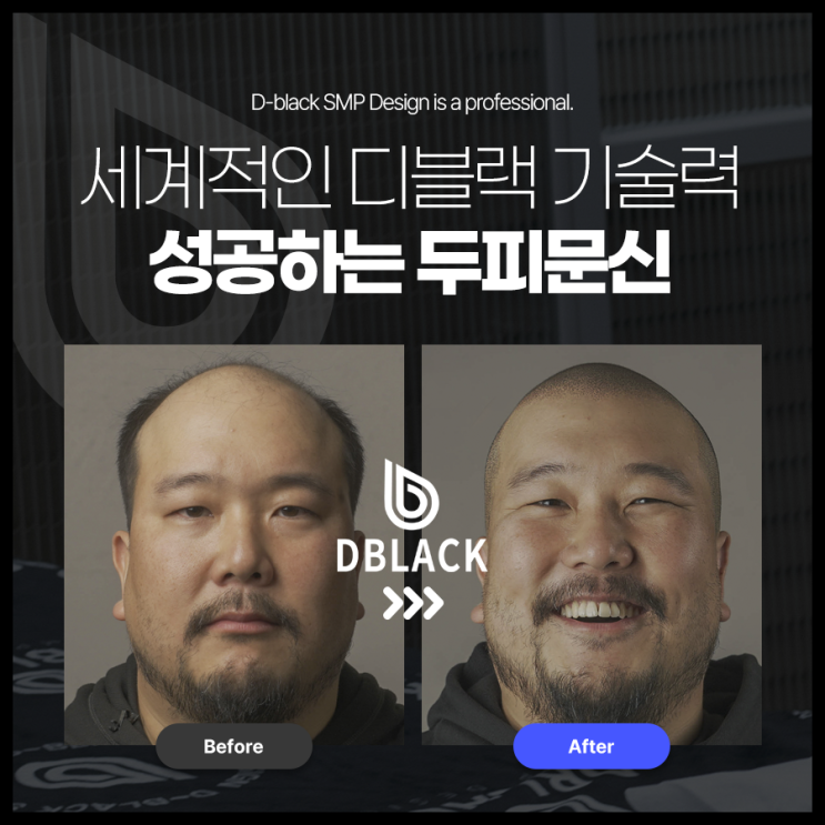  헤어라인 고민? 강남 디블랙 두피 플랜팅으로 스타일과 자신감을 동시에