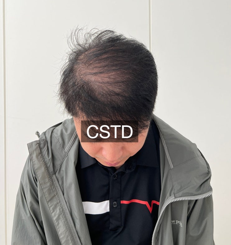  광주 두피문신 정수리를 많이 받게 되는 이유