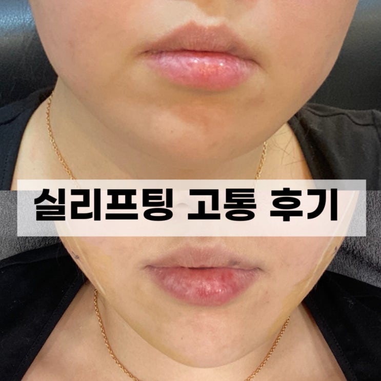  실리프팅 후기 : 고통 리뷰 재벌 리프팅 강남역 성형외과