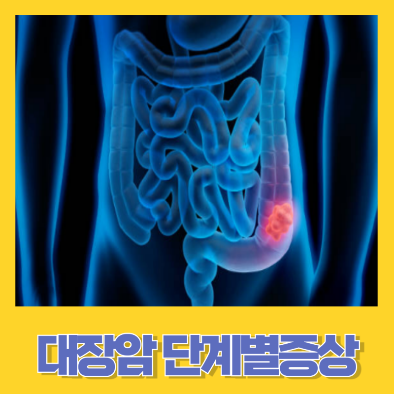 대장암 초기증상과 단계별 증상, 1기증상, 말기증상, 혈변관계