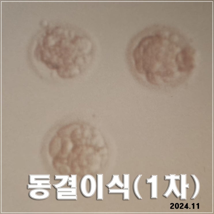  동결이식 1차 : 3일 배양 3개 이식 · 엄청난 주사 처방