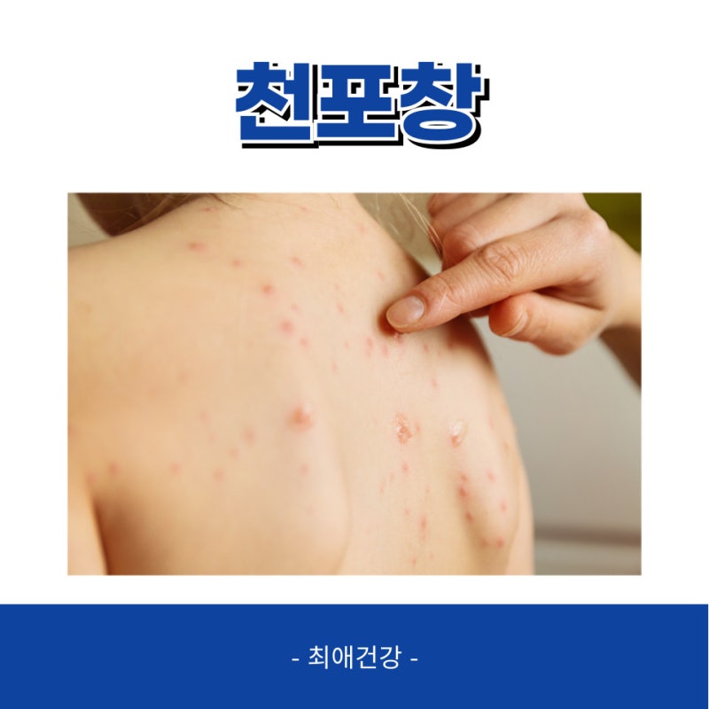 천포창 원인 유형 증상 치료