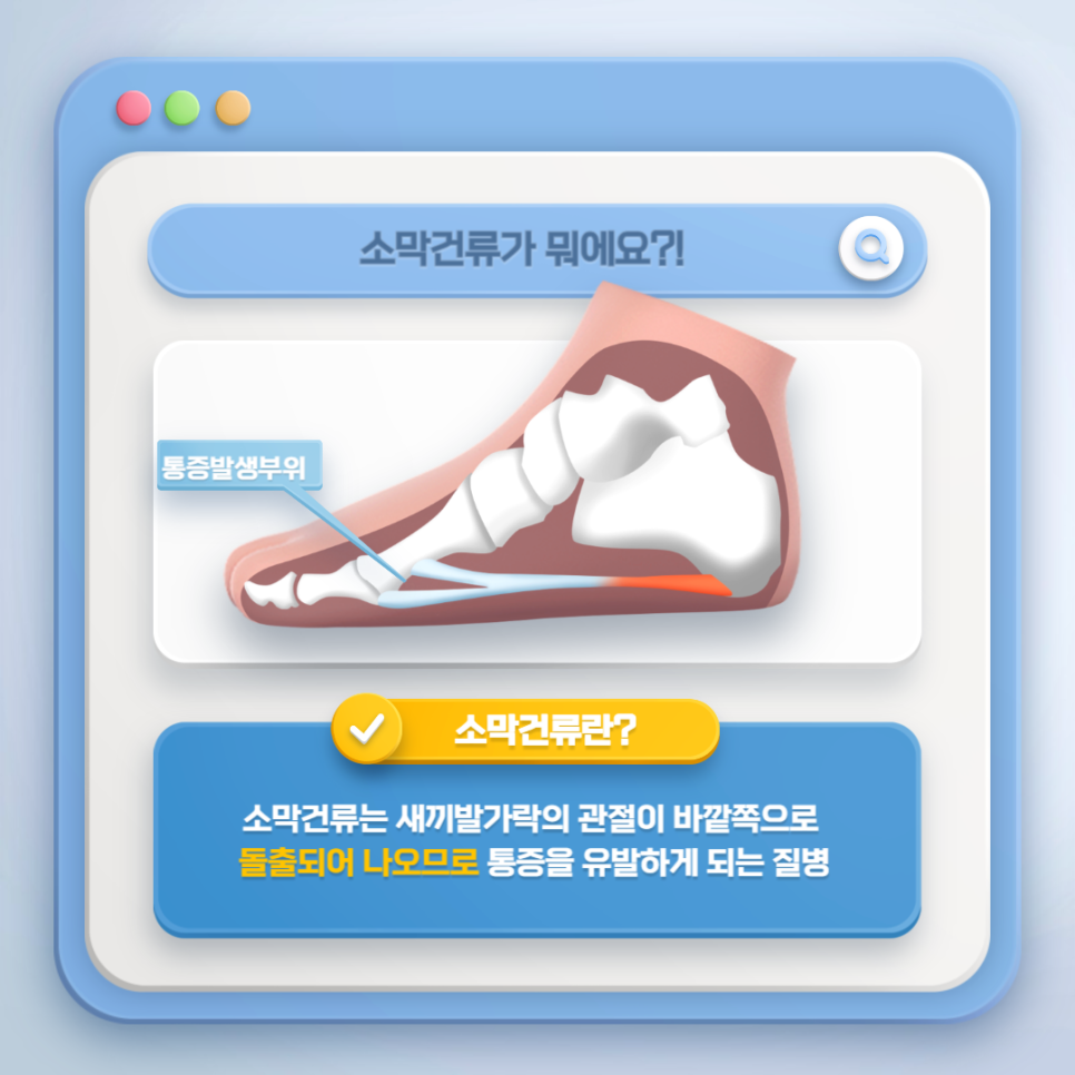 새끼 발가락이 아파요: 소막건류 — 본문 그림