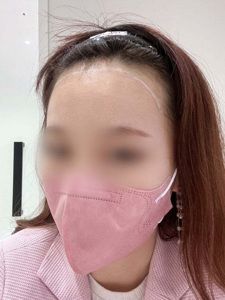 20대 여성이 헤어라인 모발이식에 실패한 이유