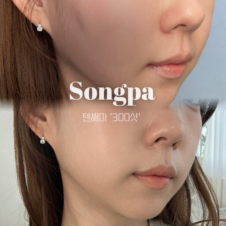  잠실 송파 피부과 | 텐써마 300샷 통증 볼패임 효과 땅콩형얼굴 찐 후기