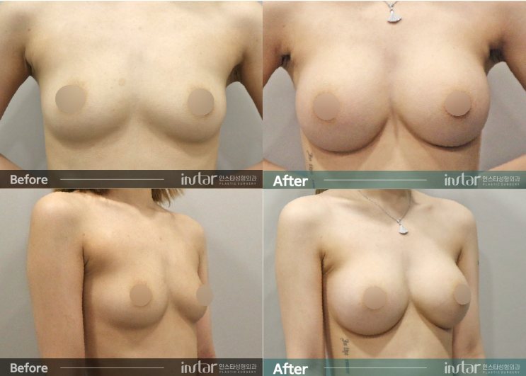  작은 흉곽 가슴 성형 : AA컵에서 C컵으로 개선 모티바 demi 285cc 265cc