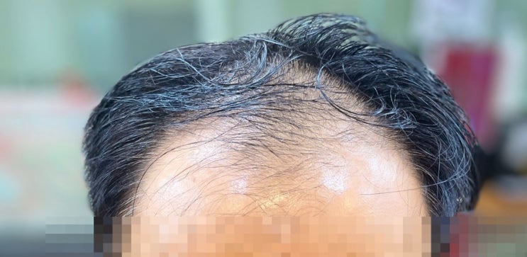  M자깊은탈모와정수리복합탈모 결혼식헤어및 일상헤어 탈모커버펌 부산추천 탈모관리에서 커버스타일 복구헤어잘하는미용실 르네시떼6층 헤어샵