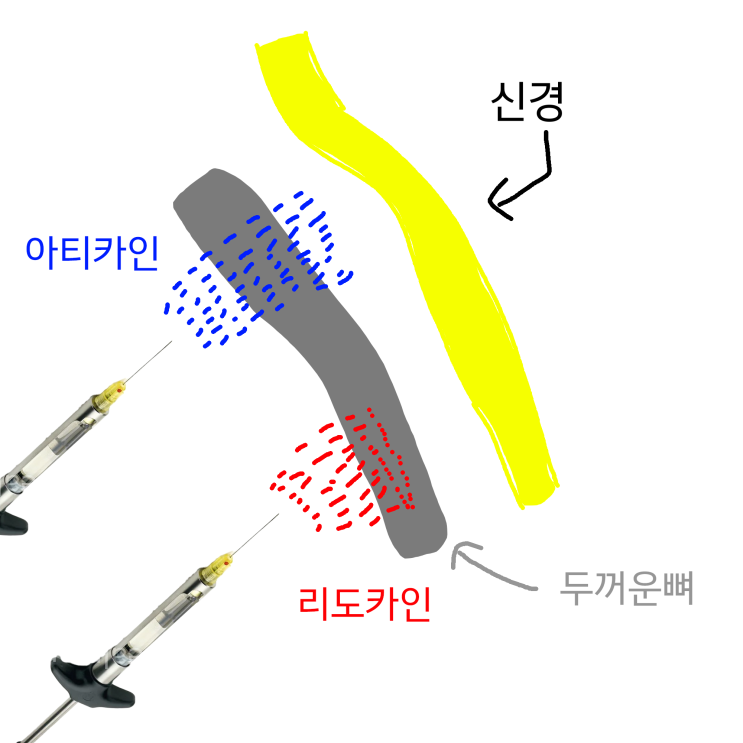  치과 국소 마취제 아티카인(Articaine)