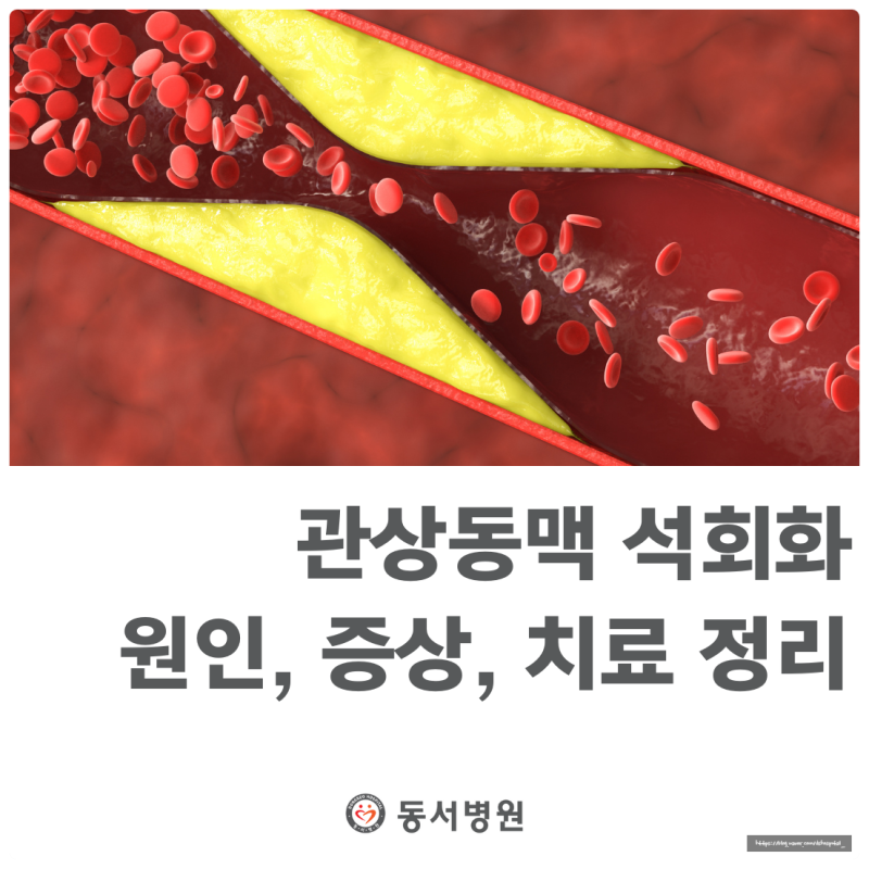 관상동맥 석회화 발생원인과 치료방법