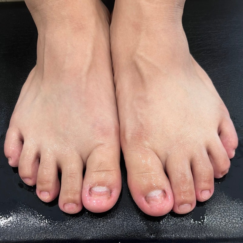 신곡동 내성발톱 무좀치료 꼼꼼 케어 리뷰
