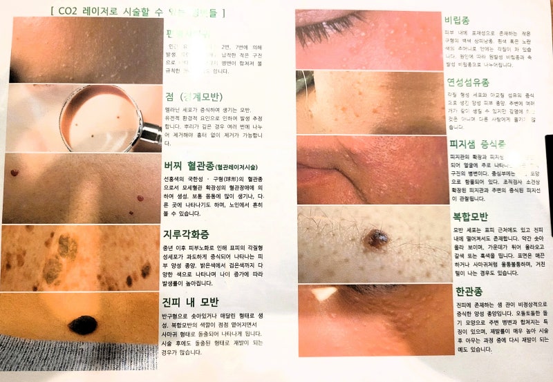 서울 잡티 제거 성지 점 비립종 쥐젖 1개에 1100원 강북구 수유동 수유역 피부과 ♡ 라르떼 ♡....