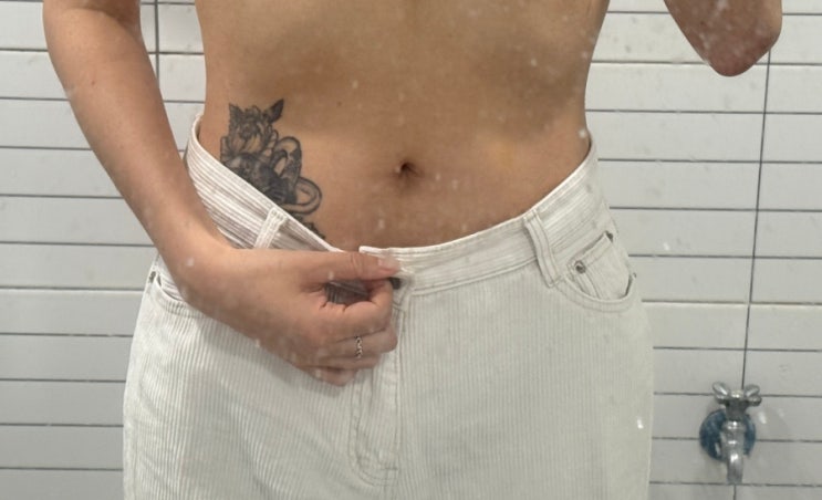  복부 러브핸들 지방흡입주사 1달 차 후기