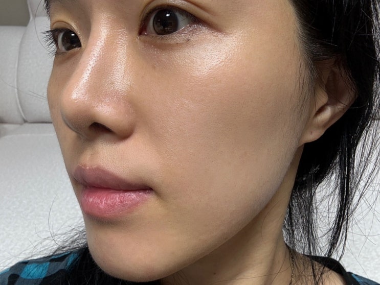  대구 범어동 피부과 리쥬란 엠보 통증 솔직한 후기