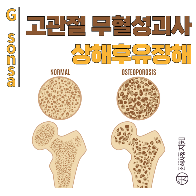  고관절 무혈성괴사, 뼈가 괴사하는 무서운 질환 - 〔아빠의 질병, 1부