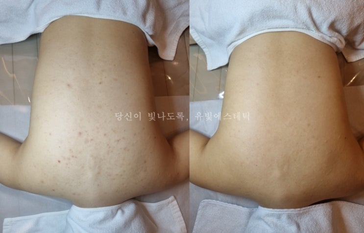 삼송 지축 원흥 등드름 피부관리 약초필 알라딘필링 유빛에스테틱