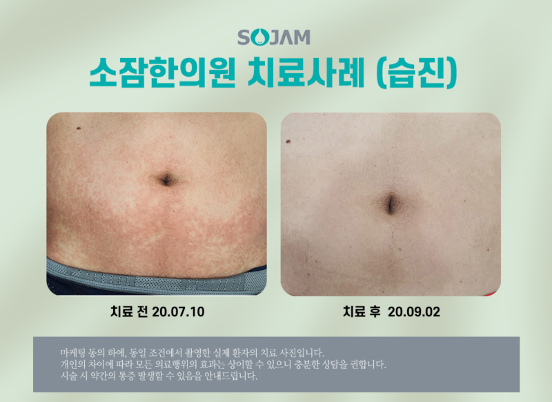습진치료, 26년 노하우로 치료합니다