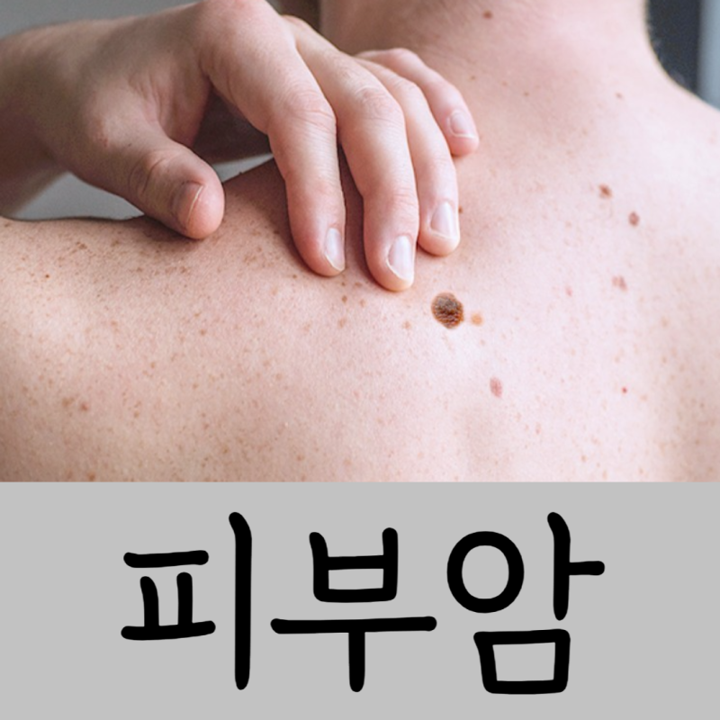 피부암 종류 전조증상 1기 초기 검사 예방