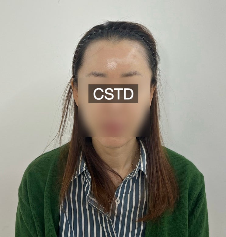  광주 여자 헤어라인 티 안나게 예뻐지는 방법