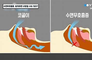 코골이의원인 및 증상과치료